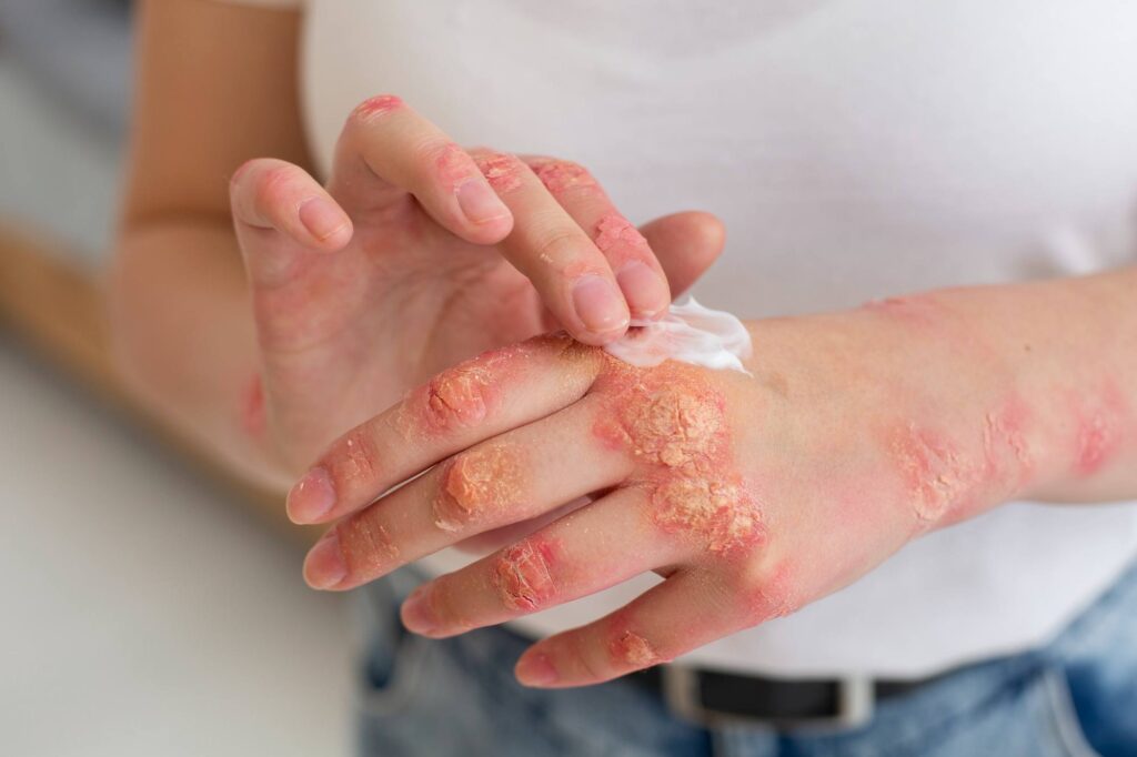 Lady applying cream