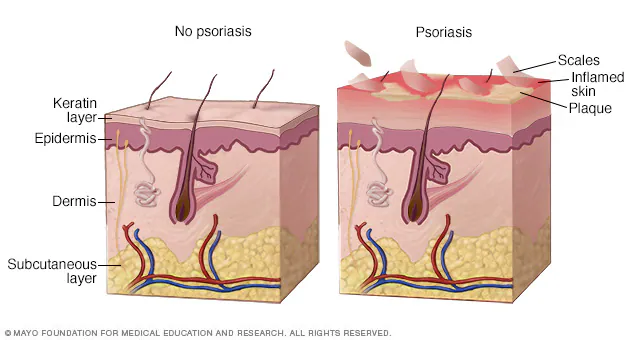 normal skin vs psoriasis skin