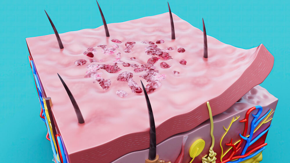 psoriasis in healthy skin layers.