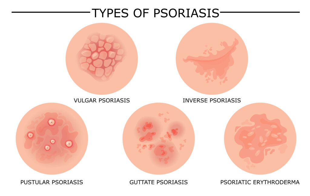 Different types of psoriasis